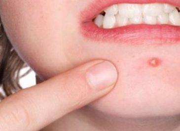 Memiliki Jerawat di Area Bibir? Kenali Beberapa Penyebabnya!