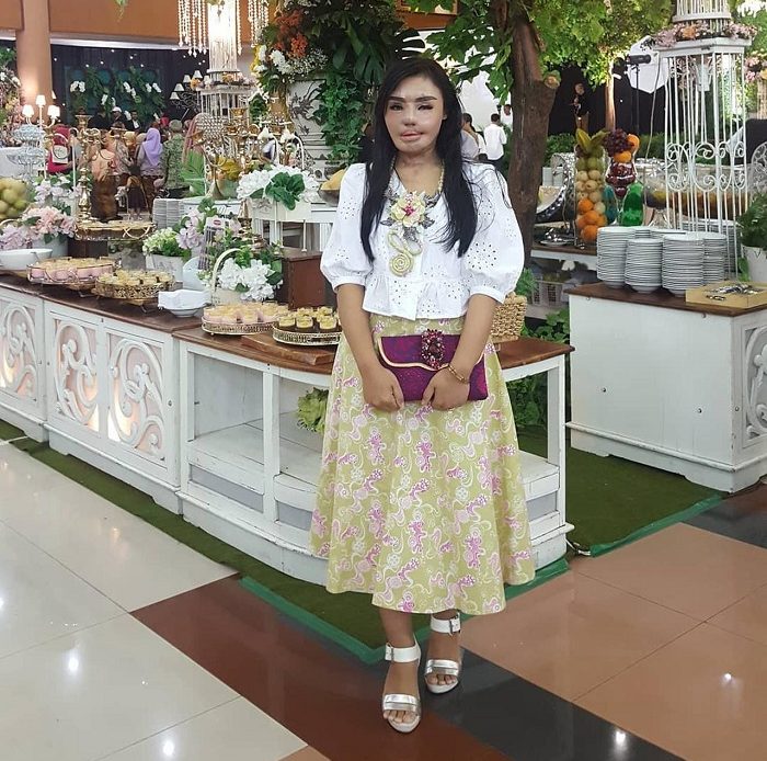 Cerita Lisa Dari Korban Penyiraman Air Keras Jadi Entrepreneur Aksesoris